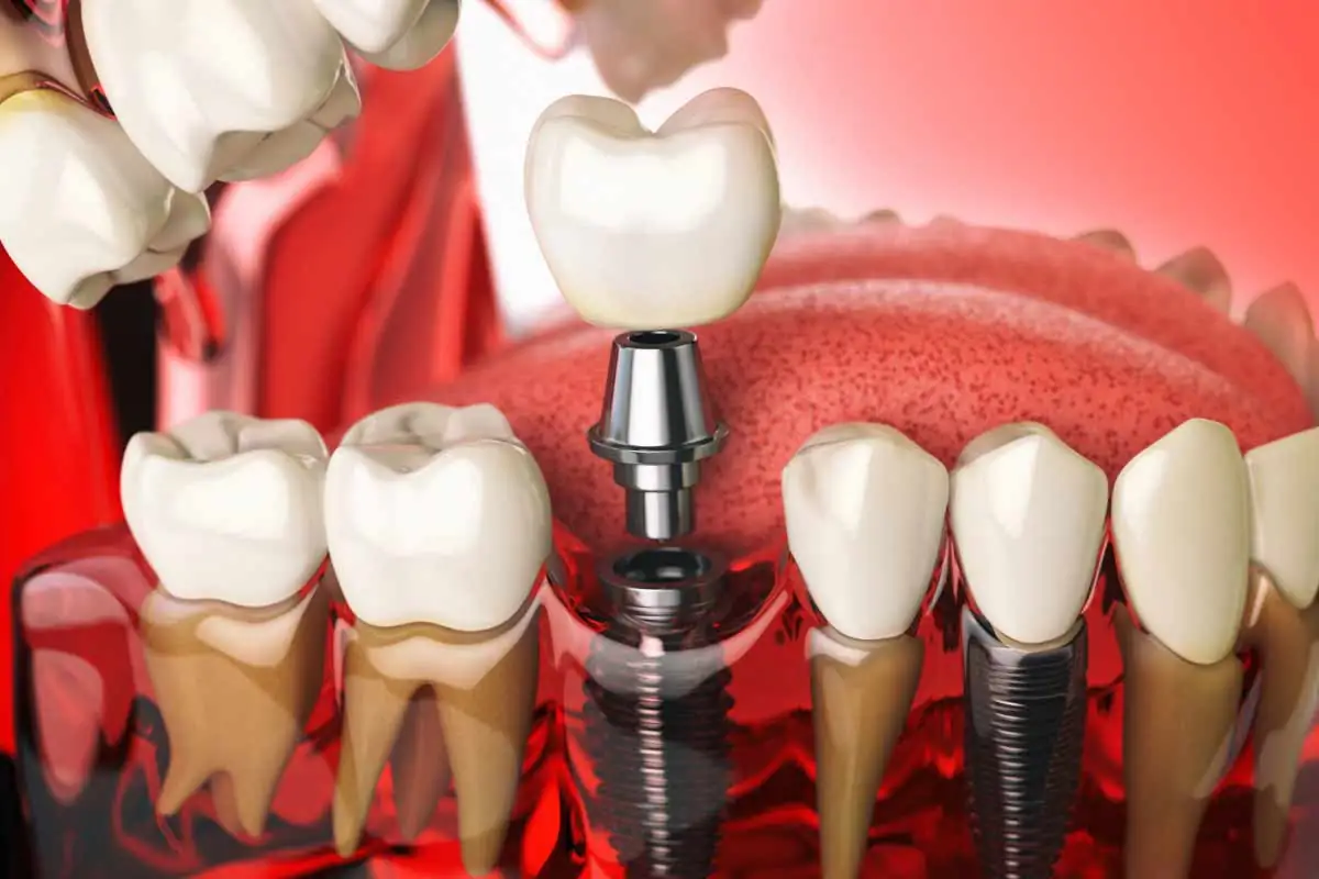 3D model showing how a dental implant is placed