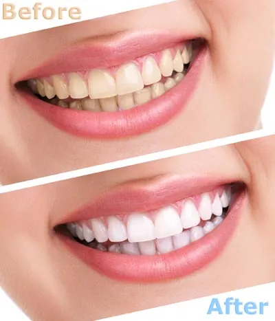 before and after photos of a patient's smile when they got teeth whitening from Brite Dental Partners